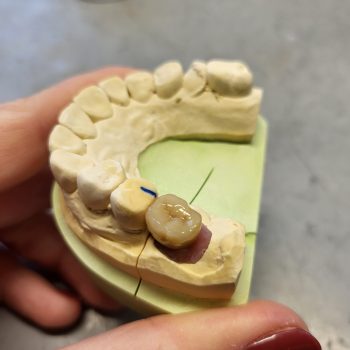 implantatgetragene Seitenzahnkrone aus Zirkonoxid